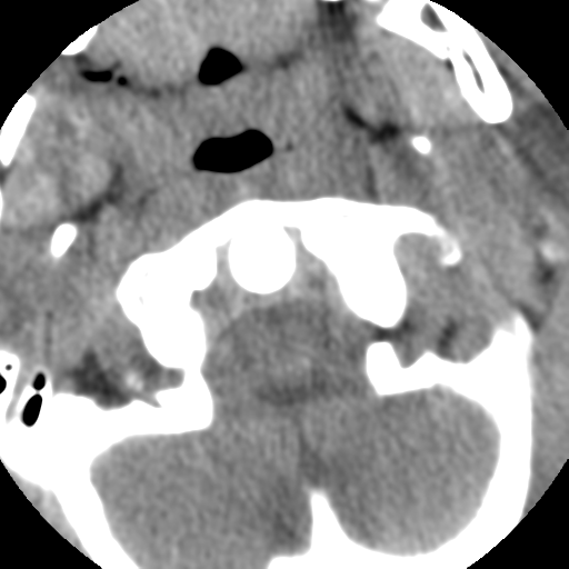 Normal trauma cervical spine (Radiopaedia 41017-43760 Axial non-contrast 12).png