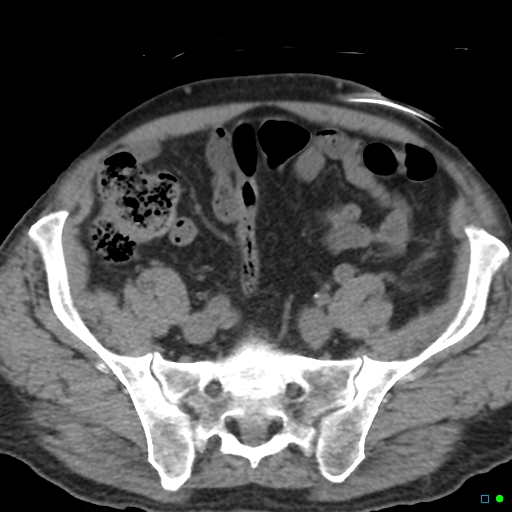 File:Obstructed Tenckhoff peritoneal dialysis catheter (Radiopaedia 37858-39789 Axial non-contrast 1).jpg