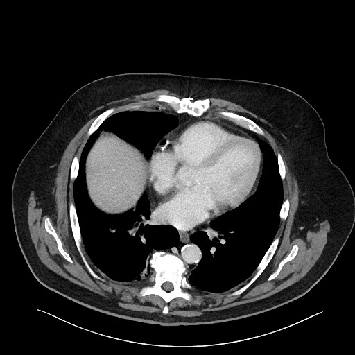 Obstructing sigmoid adenocarcinoma (Radiopaedia 58465-65619 A 10).jpg