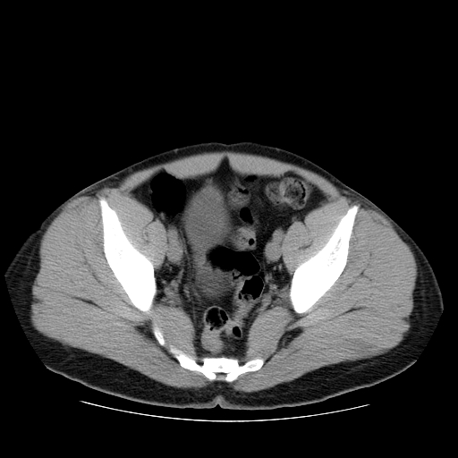 File:Obstructing ureteric calculus (Radiopaedia 18615-18514 Axial non-contrast 47).jpg