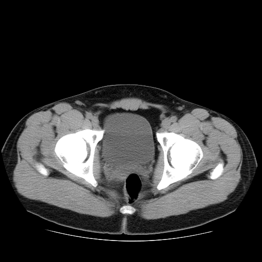 File:Obstructing ureteric calculus (Radiopaedia 18615-18514 Axial non-contrast 53).jpg