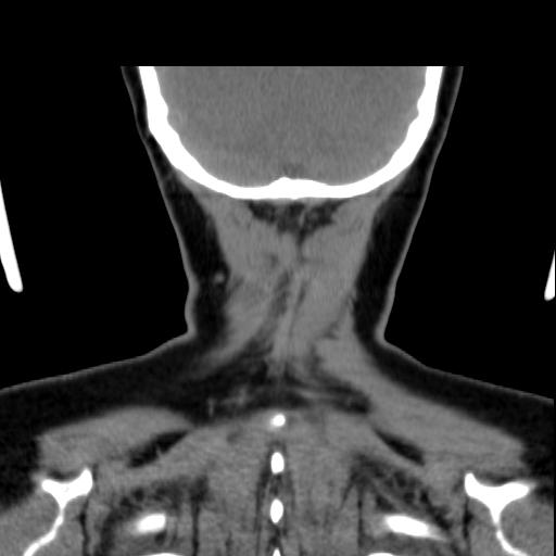 File:Obstructive sleep apnea (CT evaluation) (Radiopaedia 24304-24582 Coronal non-contrast 89).jpg