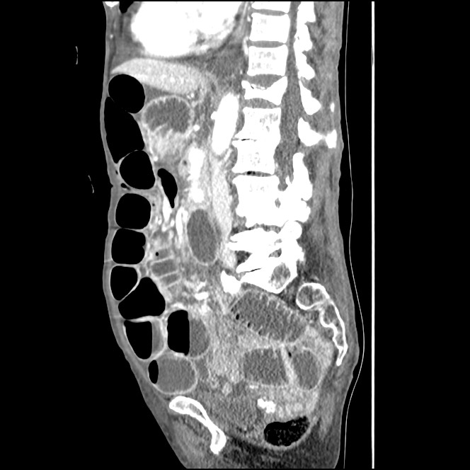 Obturator hernia causing small bowel obstruction (Radiopaedia 65522-74612 C 53).jpg
