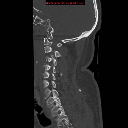 File:Occipital condyle fracture (Radiopaedia 18366-18208 Sagittal bone window 12).jpg
