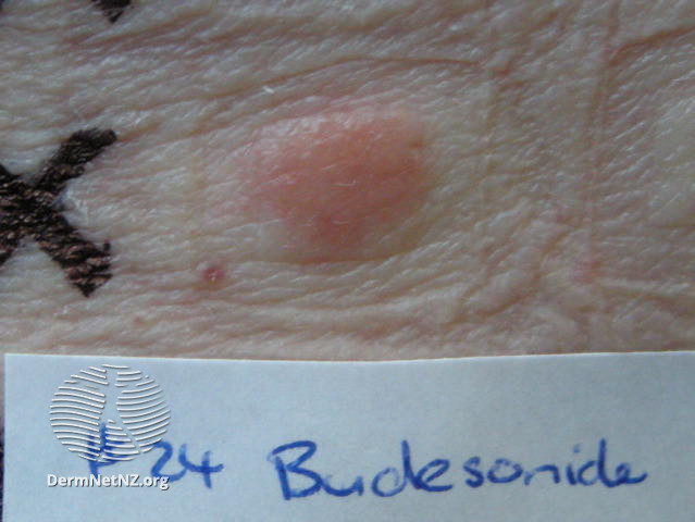 File:Positive patch test to budesonide (DermNet NZ dermatitis-budesonide-patch).jpg
