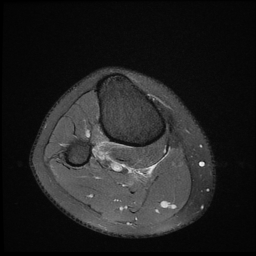 File:ACL acute full thickness tear - deep lateral femoral sulcus sign (Radiopaedia 38594-40740 Axial PD fat sat 26).jpg