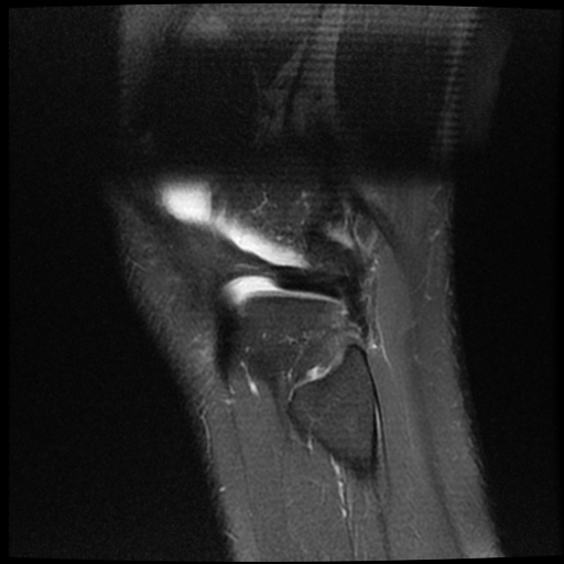 File:ACL acute full thickness tear - deep lateral femoral sulcus sign (Radiopaedia 38594-40740 Sagittal PD fat sat 20).jpg