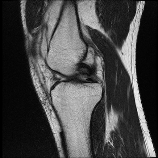File:ACL acute full thickness tear - deep lateral femoral sulcus sign (Radiopaedia 38594-40740 Sagittal T2 8).jpg