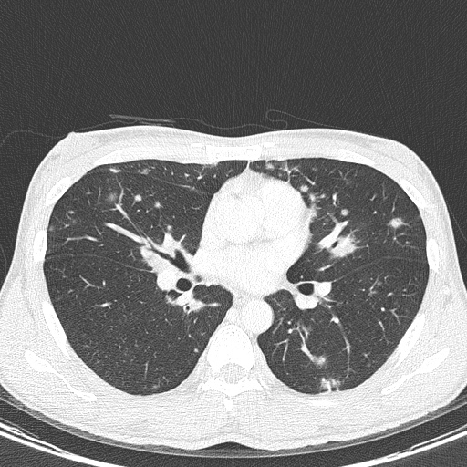 AIDS-related Kaposi sarcoma (Radiopaedia 85247-100811 Axial lung window 86).jpg