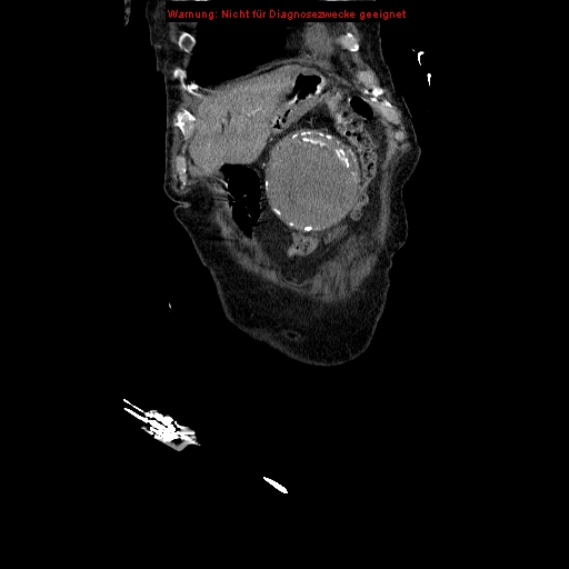 Abdominal aortic aneurysm- extremely large, ruptured (Radiopaedia 19882-19921 Coronal C+ arterial phase 16).jpg