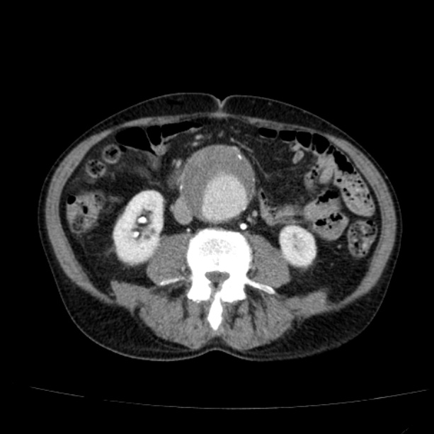 Abdominal aortic aneurysm (Radiopaedia 29248-29660 Axial C+ portal venous phase 33).jpg
