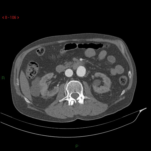 Abdominal aortic aneurysm rupture with aortocaval fistula (Radiopaedia 14897-14841 Axial C+ arterial phase 106).jpg