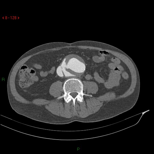Abdominal aortic aneurysm rupture with aortocaval fistula (Radiopaedia 14897-14841 Axial C+ arterial phase 128).jpg