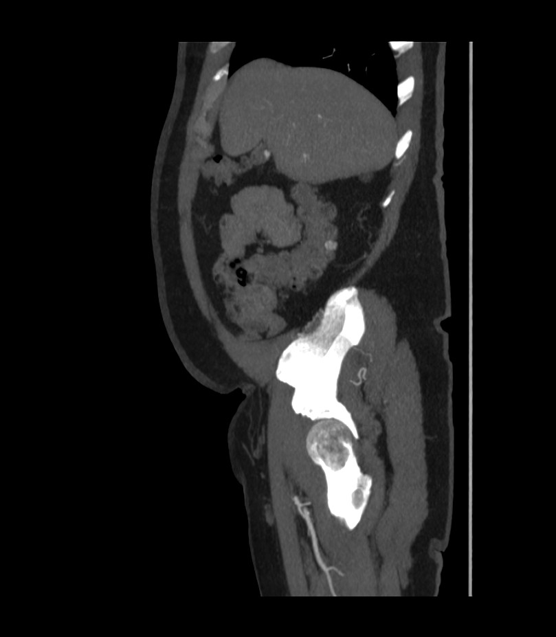 Abdominal aortic aneurysm with thrombus fissuration (Radiopaedia 46218-50618 Sagittal C+ arterial phase 10).jpg