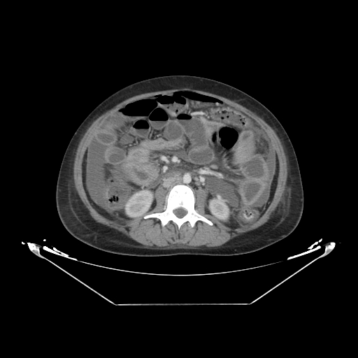 Abdominal gossypiboma- surgical towel (Radiopaedia 57288-64226 Axial C+ portal venous phase 33).jpg