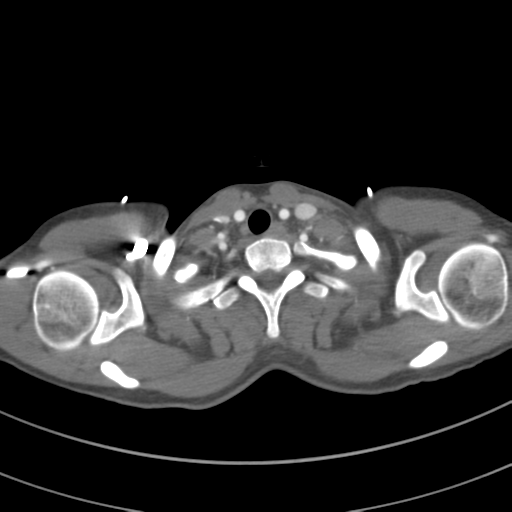 Abdominal multi-trauma - devascularised kidney and liver, spleen and pancreatic lacerations (Radiopaedia 34984-36486 Axial C+ arterial phase 9).png
