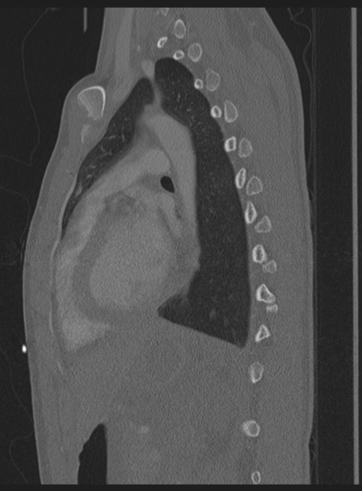 Abdominal multi-trauma - devascularised kidney and liver, spleen and pancreatic lacerations (Radiopaedia 34984-36486 Sagittal bone window 17).png