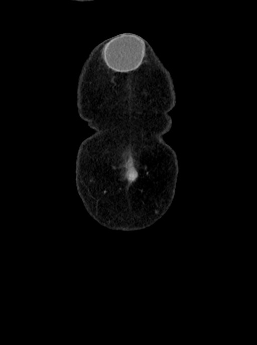 Abdominal wall and retroperitoneal tuberculosis (Radiopaedia 88137-104729 Coronal C+ portal venous phase 7).jpg