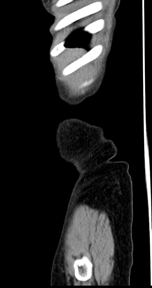 Abdominal wall and retroperitoneal tuberculosis (Radiopaedia 88137-104729 Sagittal C+ portal venous phase 142).jpg