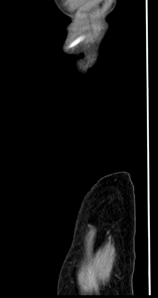 Abdominal wall and retroperitoneal tuberculosis (Radiopaedia 88137-104729 Sagittal C+ portal venous phase 146).jpg