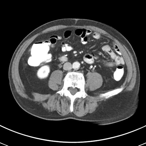 Abdominal wall metastasis from colorectal carcinoma (Radiopaedia 31016-31717 Axial C+ portal venous phase 43).jpg