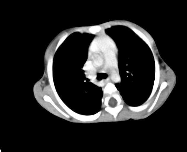 Abdominopelvic rhabdomyosarcoma (Radiopaedia 78356-90984 Axial C+ portal venous phase 15).jpg