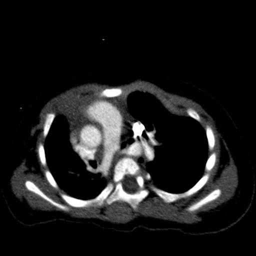 Aberrant left pulmonary artery (pulmonary sling) (Radiopaedia 42323-45435 Axial C+ CTPA 19).jpg