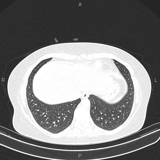 Aberrant right subclavian artery (Radiopaedia 87334-103629 Axial lung window 53).jpg