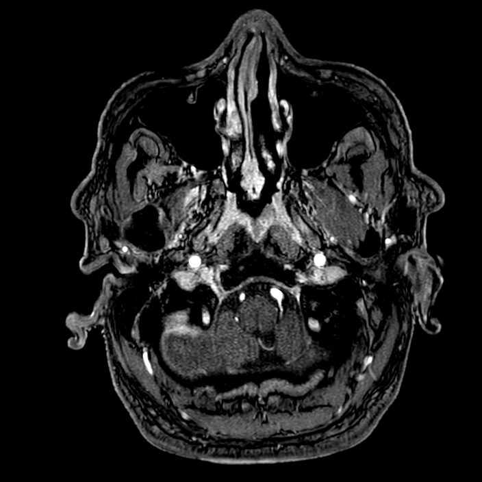 Accessory middle cerebral artery (Radiopaedia 73114-83828 Axial MRA 7).jpg