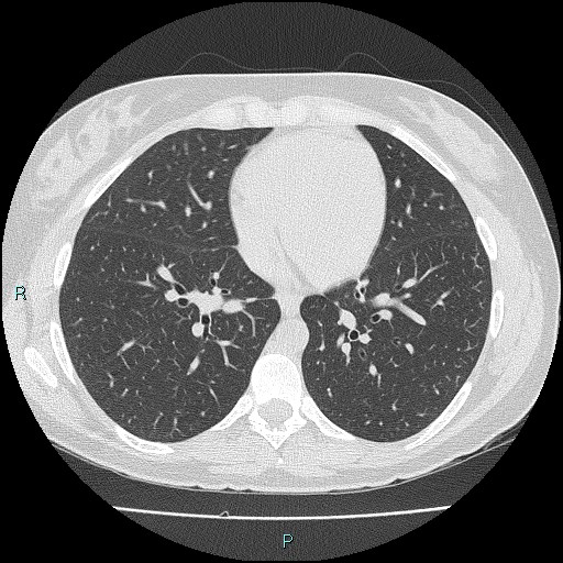 File:Accidental foreign body aspiration (seamstress needle) (Radiopaedia 77740-89983 Axial lung window 41).jpg