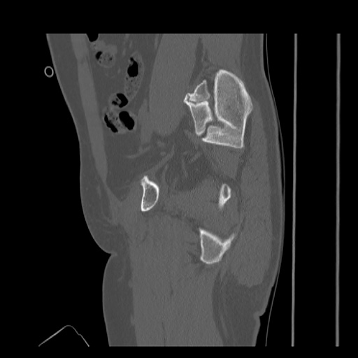 File:Acetabular and ilial fractures (Radiopaedia 59084-66378 Sagittal bone window 36).jpg