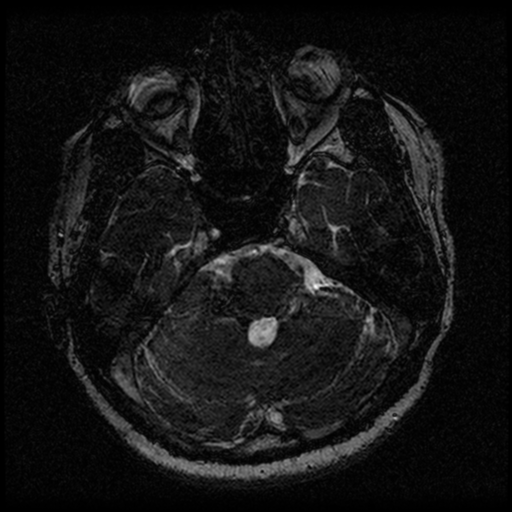 Acoustic schwannoma (Radiopaedia 33045-34060 Axial T2 42).png