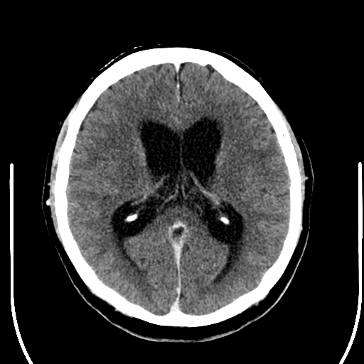 File:Acoustic schwannoma (Radiopaedia 39170-41389 Axial C+ 16).png