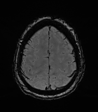 Acoustic schwannoma (Radiopaedia 50846-56358 Axial SWI 78).png