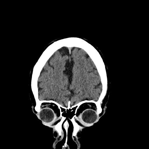 File:Acoustic schwannoma (Radiopaedia 55729-62280 Coronal non-contrast 9).png