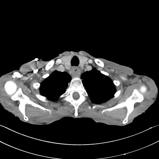 File:Acquired tracheoesophageal fistula (Radiopaedia 57747-65042 Axial C+ portal venous phase 9).jpg