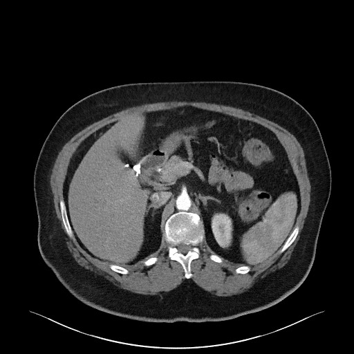 Acromioclavicular joint cyst (Radiopaedia 58455-65610 Axial C+ arterial phase 109).jpg