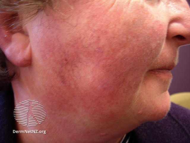 Actinic Keratoses treated with imiquimod (DermNet NZ lesions-ak-imiquimod-3727).jpg
