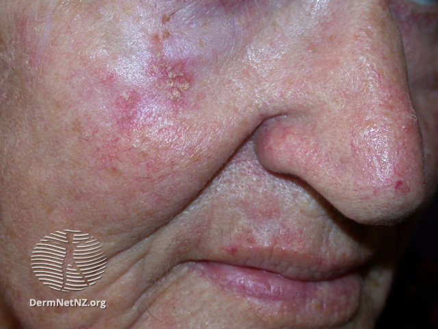 Actinic Keratoses treated with imiquimod (DermNet NZ lesions-ak-imiquimod-3731).jpg