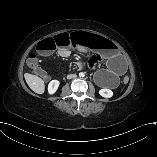 File:Active Crohn disease (Radiopaedia 59394-66750 Axial C+ portal venous phase 38).jpg