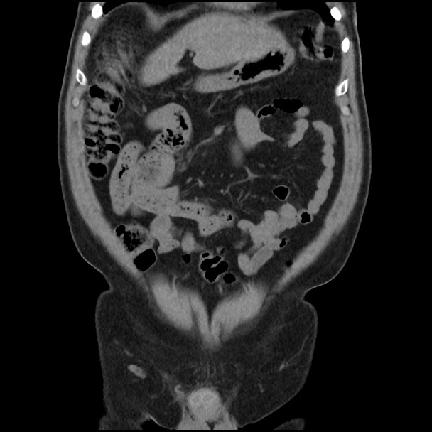 Active colonic bleed on CT (Radiopaedia 49765-55025 Coronal non-contrast 16).jpg