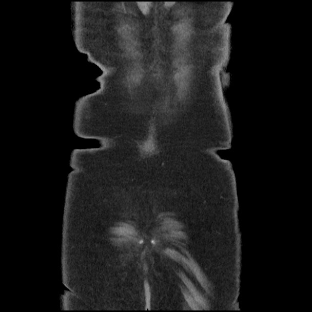 Active colonic bleed on CT (Radiopaedia 49765-55025 Coronal non-contrast 53).jpg