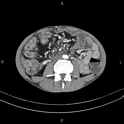 Active crohn disease (Radiopaedia 87133-103397 Axial C+ arterial phase 57).jpg