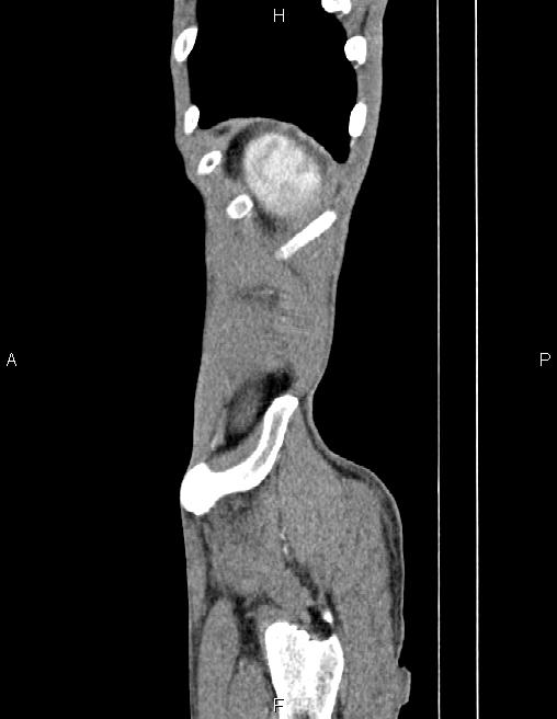 Active crohn disease (Radiopaedia 87133-103397 Sagittal C+ arterial phase 84).jpg