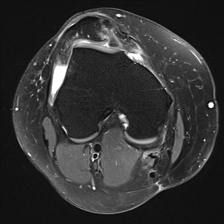 File:Acute-on-chronic transient lateral patellar dislocation with trochlear dysplasia (Radiopaedia 84099-99349 Axial PD fat sat 14).jpg