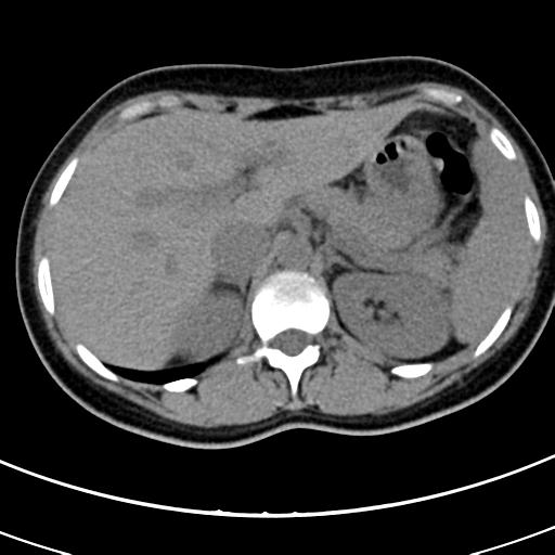 Acute appendicitis (Radiopaedia 30261-30888 Axial non-contrast 9).jpg