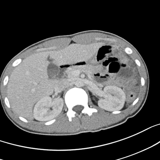 Acute appendicitis (Radiopaedia 32614-33572 Axial C+ portal venous phase 19).jpg