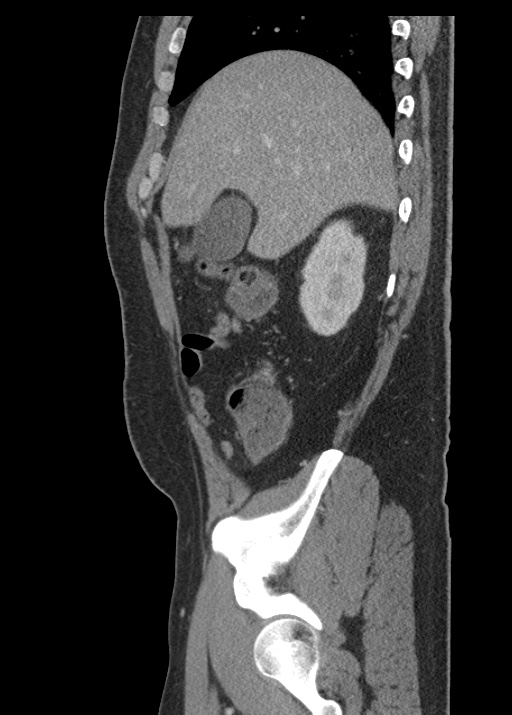 Acute appendicitis (Radiopaedia 48511-53463 Sagittal C+ portal venous phase 39).jpg