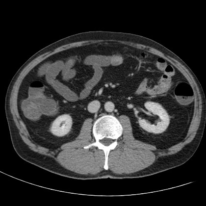 Acute appendicitis (Radiopaedia 66513-75790 Axial C+ portal venous phase 33).jpg