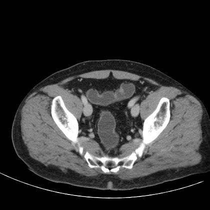 File:Acute appendicitis (Radiopaedia 66513-75790 Axial C+ portal venous phase 77).jpg